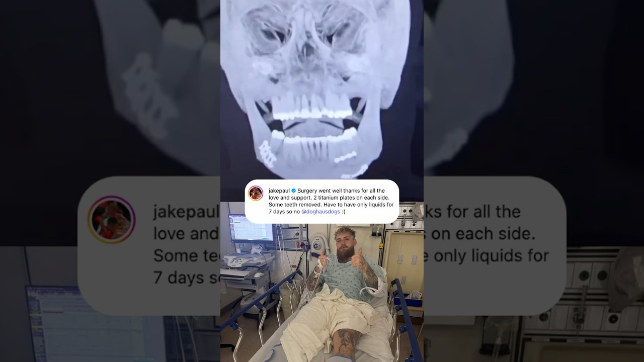 Jake Paul underwent successful jaw surgery 🙏