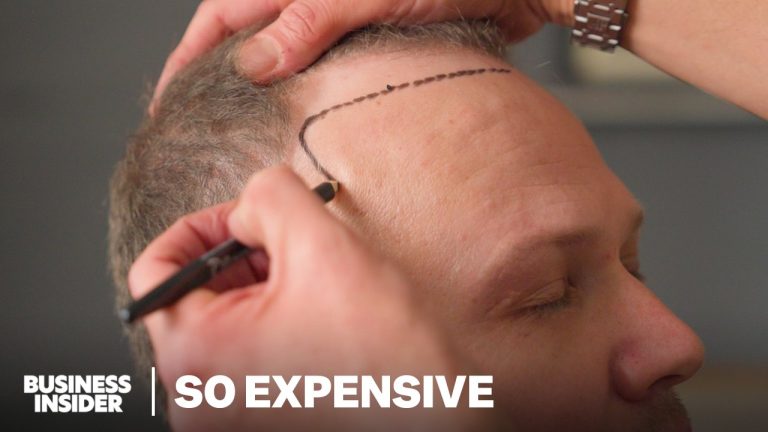 Inside Turkey’s $2B Hair Transplant Tourism Boom